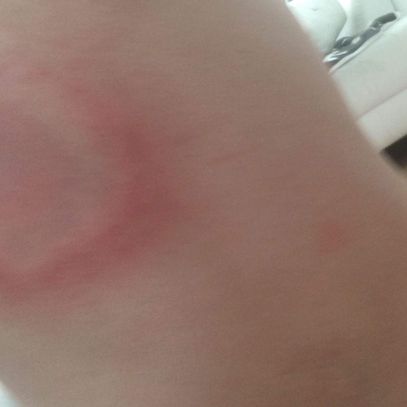 Anzeichen Blutvergiftung Nach Insektenstich Anzeichen Blutvergiftung Nach Insektenstich