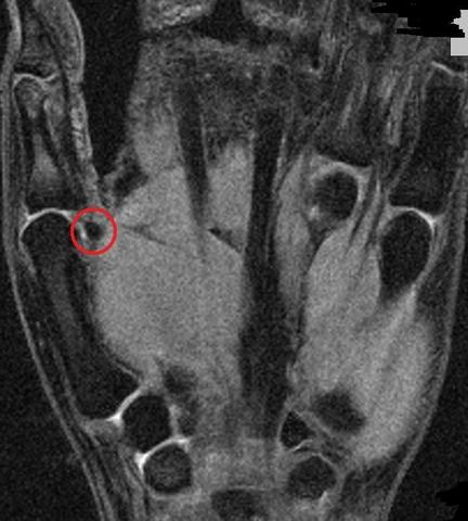Hilfe Daumen Medizin Verletzung Orthopade