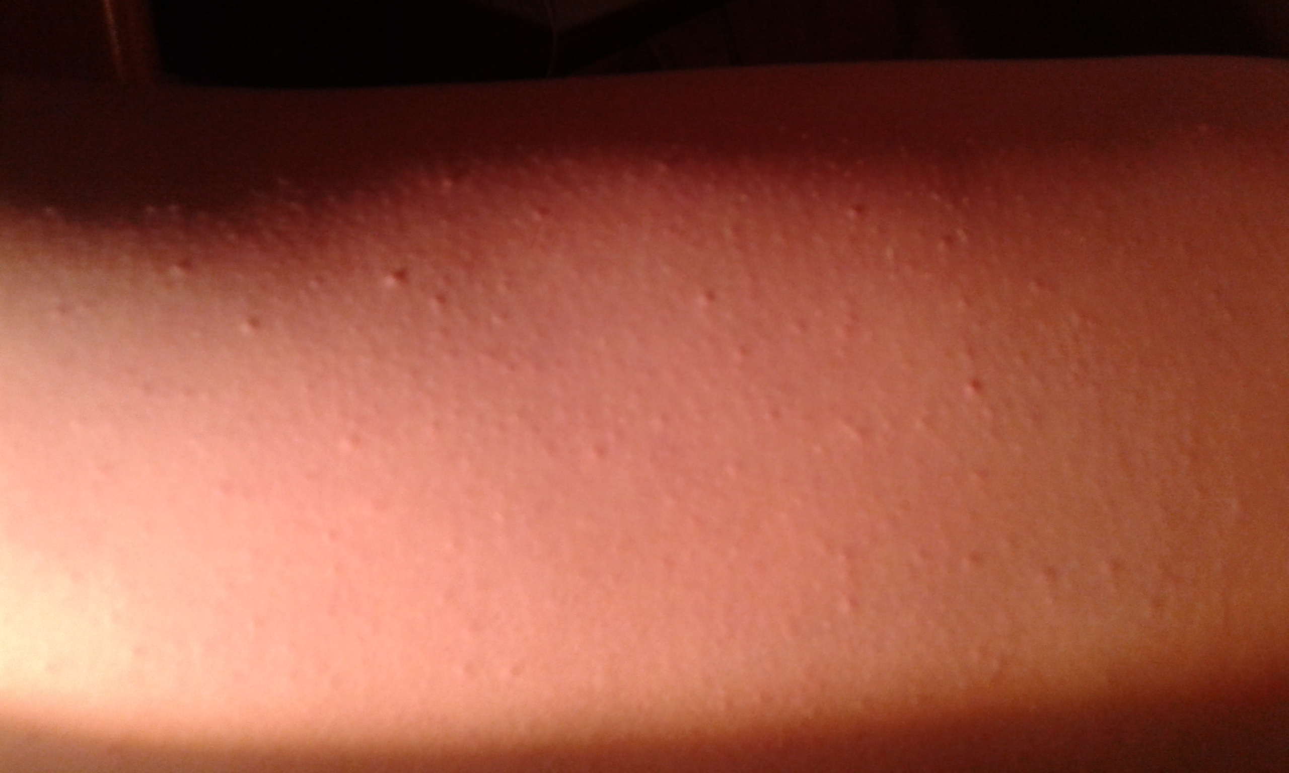 HILFE D:,Was sind das für Pickel auf meinem ganzen Körper? (Haut, Pflege, Allergie) pickel körper