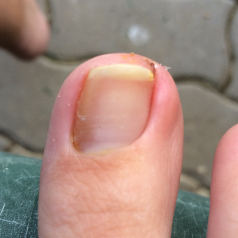 Hilfe! Eingewachsener eitriger Zehennagel! (Angst, Fußpflege, eitrig)