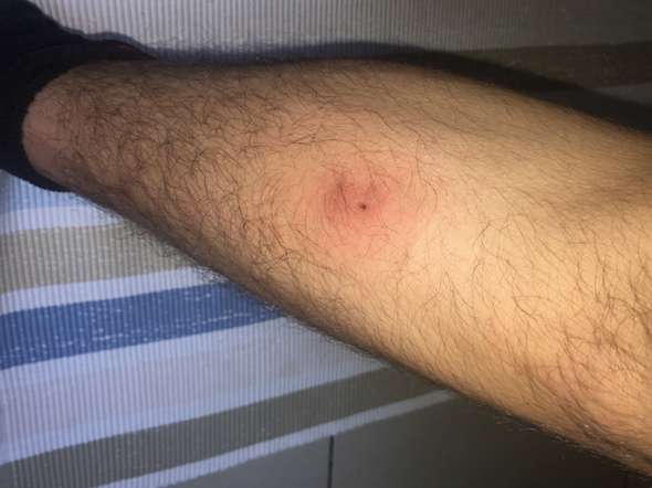 Hilfe Entzundung Oder Blutvergiftung Insektenstich Schmerzhaft Hilfe Entzundung Oder Blutvergiftung Insektenstich Schmerzhaft