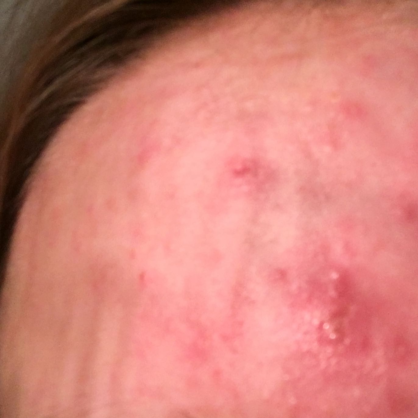 Hilfe! Extreme wunde nach Pickel. Was tun? (Medizin, Beauty, PubertƤt) pickel hinterkopf