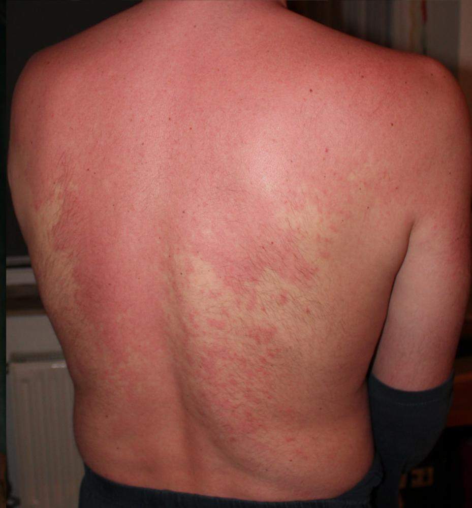 HILFE! Extremer Hautausschlag (Bilder im Anhang) Was könnte das sein HILFE! Extremer Hautausschlag (Bilder im Anhang) Was könnte das sein