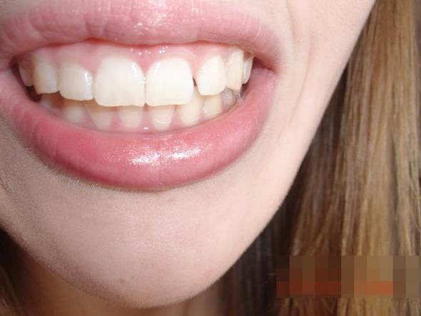 Hilfe Fallt Es Arg Auf Dass Am Schneidezahn Etwas Vom Zahn Abgebrochen Ist Gesundheit Freizeit Aussehen Hilfe Fallt Es Arg Auf Dass Am Schneidezahn Etwas Vom Zahn Abgebrochen Ist Gesundheit Freizeit Aussehen