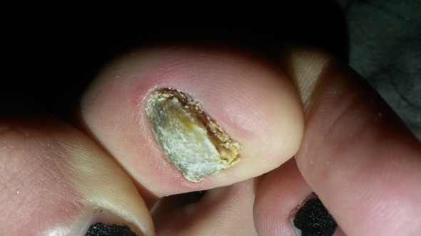 Hilfe Fussnagel Medizin Fusse Nagel Hilfe Fussnagel Medizin Fusse Nagel