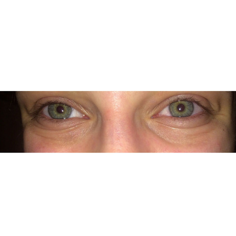 Angeschwollene Augen (mal mehr, mal weniger) - (Teenager, Augenringe, Selbstwertgefühl)