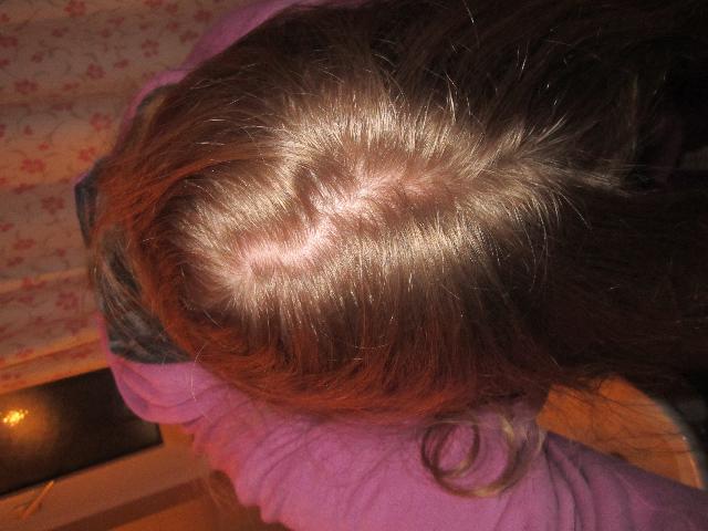 hilfe haarausfall wird immer schlimmer