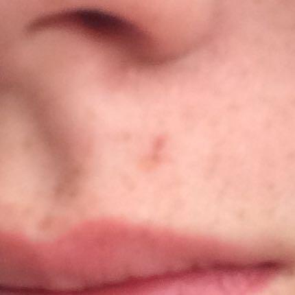 Die grosse über der Lippe
- (Wunde, Sommersprossen, Verheilen)