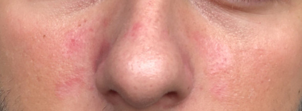 Hilfe Habe Einen Ausschlag Im Gesicht Gesundheit Und Medizin Hautausschlag Hilfe Habe Einen Ausschlag Im Gesicht Gesundheit Und Medizin Hautausschlag