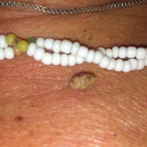 Komische Warze am Hals. Was für eine Art ist das? - (Arzt, Haut, Hals)