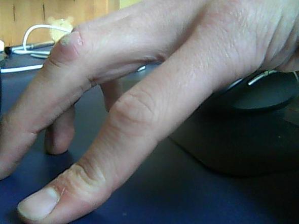 Mittelfinger - (Medizin, Arzt, Finger)