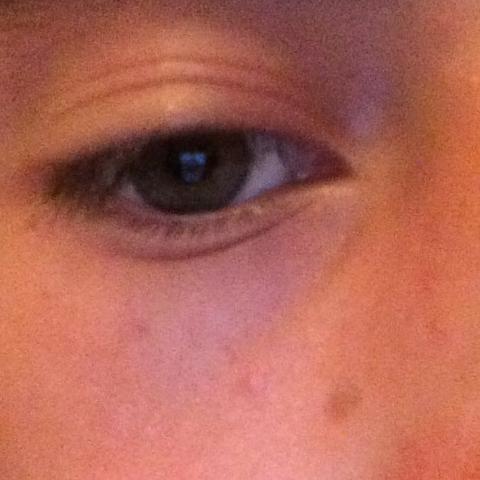 Dennie morgan falte ursache Dennie morgan falte ursache