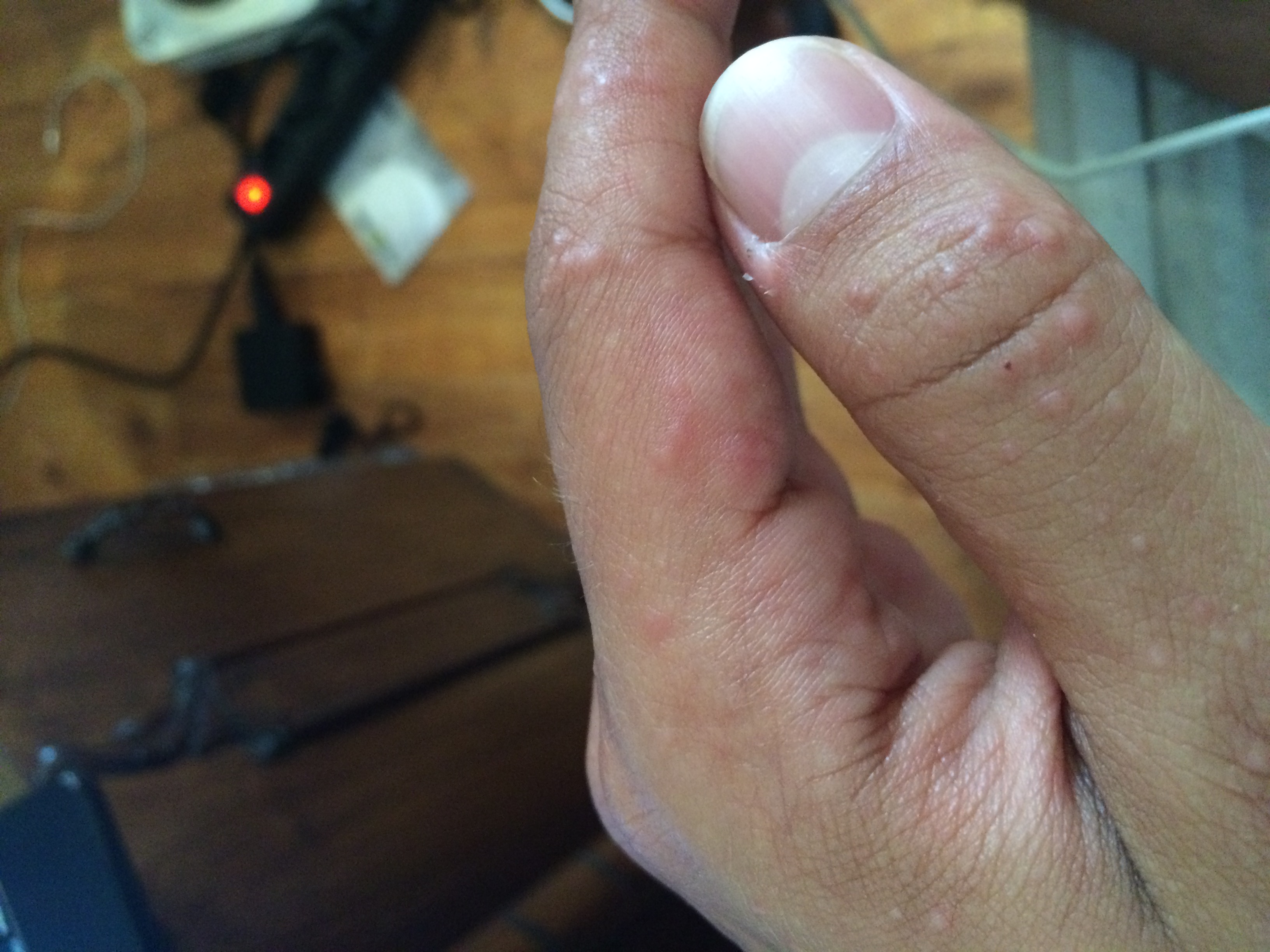 Als man kann gribok des Nagels herausführen