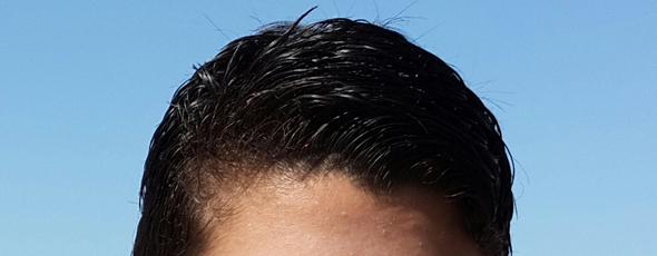 Haar - (Haarausfall, 15 Jahre alt)