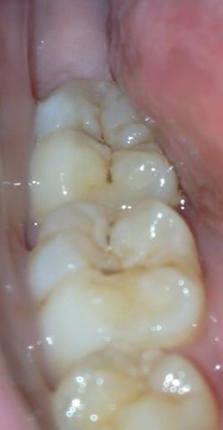 Hilfe Ich Glaube Ich Habe Karies Gesundheit Zahne