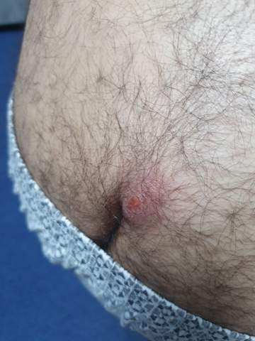 Hilfe Ich Habe An Dieser Beule Starke Schmerzen Was Kann Ich Tun Gesundheit Und Medizin Gesundheit Medizin Hilfe Ich Habe An Dieser Beule Starke Schmerzen Was Kann Ich Tun Gesundheit Und Medizin Gesundheit Medizin