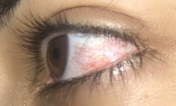 Hilfe Ich Habe Ein Haar Im Auge Das Nicht Raus Geht Gesundheit Medizin Augen Hilfe Ich Habe Ein Haar Im Auge Das Nicht Raus Geht Gesundheit Medizin Augen