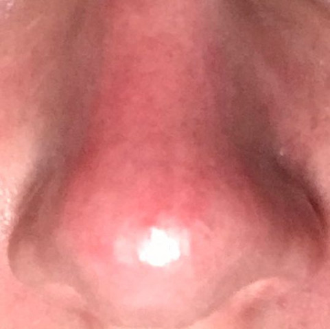 Hilfe Ich Habe Eine Sehr Rotliche Nase Was Tun Gesundheit Und Medizin Gesicht Rote Flecken Hilfe Ich Habe Eine Sehr Rotliche Nase Was Tun Gesundheit Und Medizin Gesicht Rote Flecken