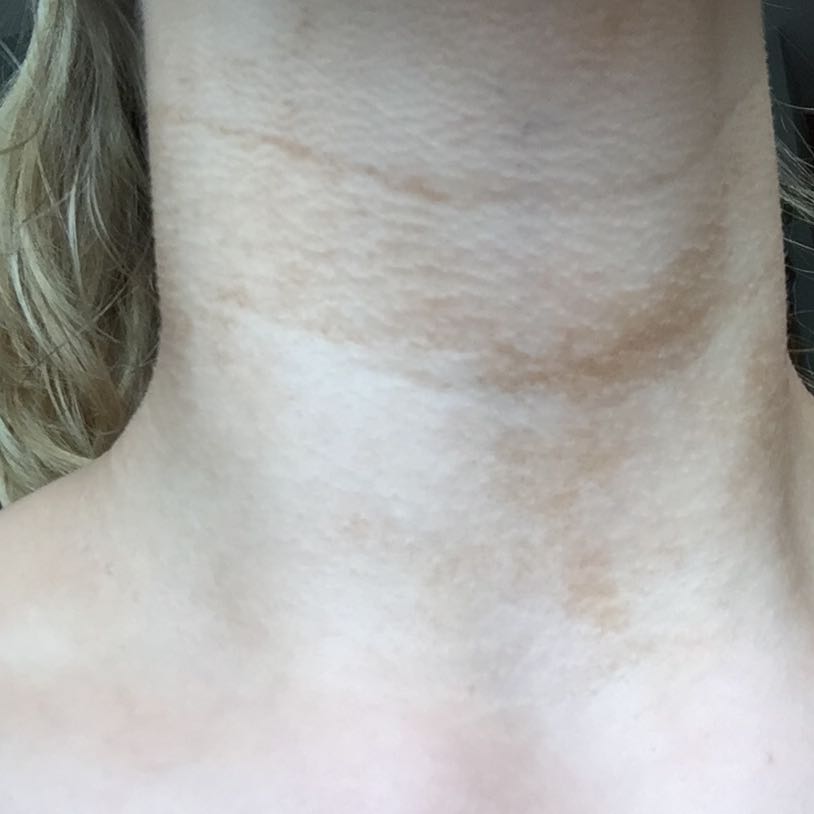 Hilfe ich habe Flecken am Hals? (Gesundheit, Haut)