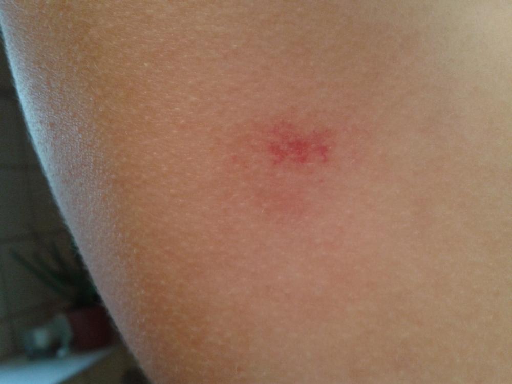 Hilfe! Ich habe so komische blaue Flecken (Freizeit, Medizin, Krankheit) Hilfe! Ich habe so komische blaue Flecken (Freizeit, Medizin, Krankheit)