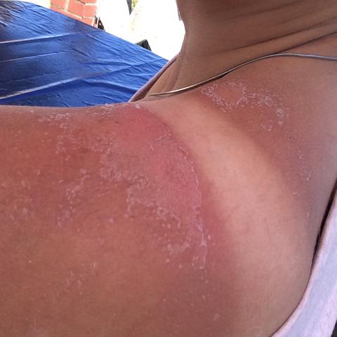 Hilfe Ich Habe Sonnenbrand Hilfe Ich Habe Sonnenbrand