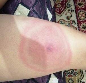 Hilfe Insektenstich Gesundheit Und Medizin Insekten Hilfe Insektenstich Gesundheit Und Medizin Insekten