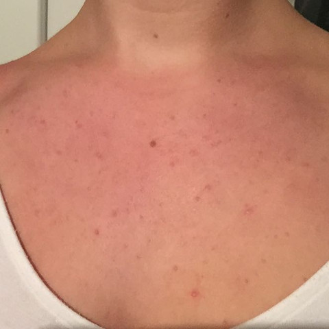 pickel dekollete pickel dekollete