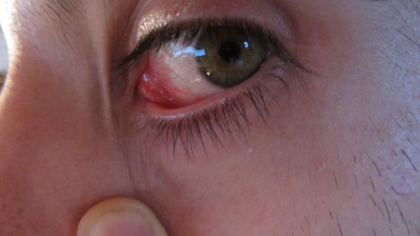 Hilfe Ist Das Eine Bindehautentzundung Arzt Schmerzen Augen