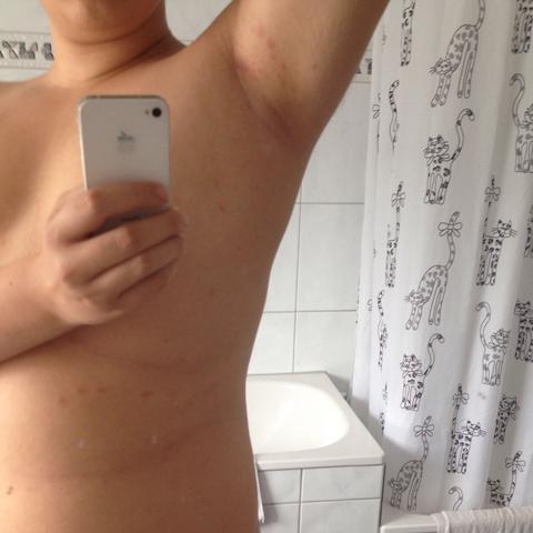 Am bauch wird es auch immer mehr finde ich - (Pickel, Punkte, Hautausschlag)