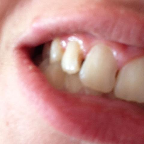 Hilfe Karies Am Schneidezahn Schmerzen Zahne Zahnarzt