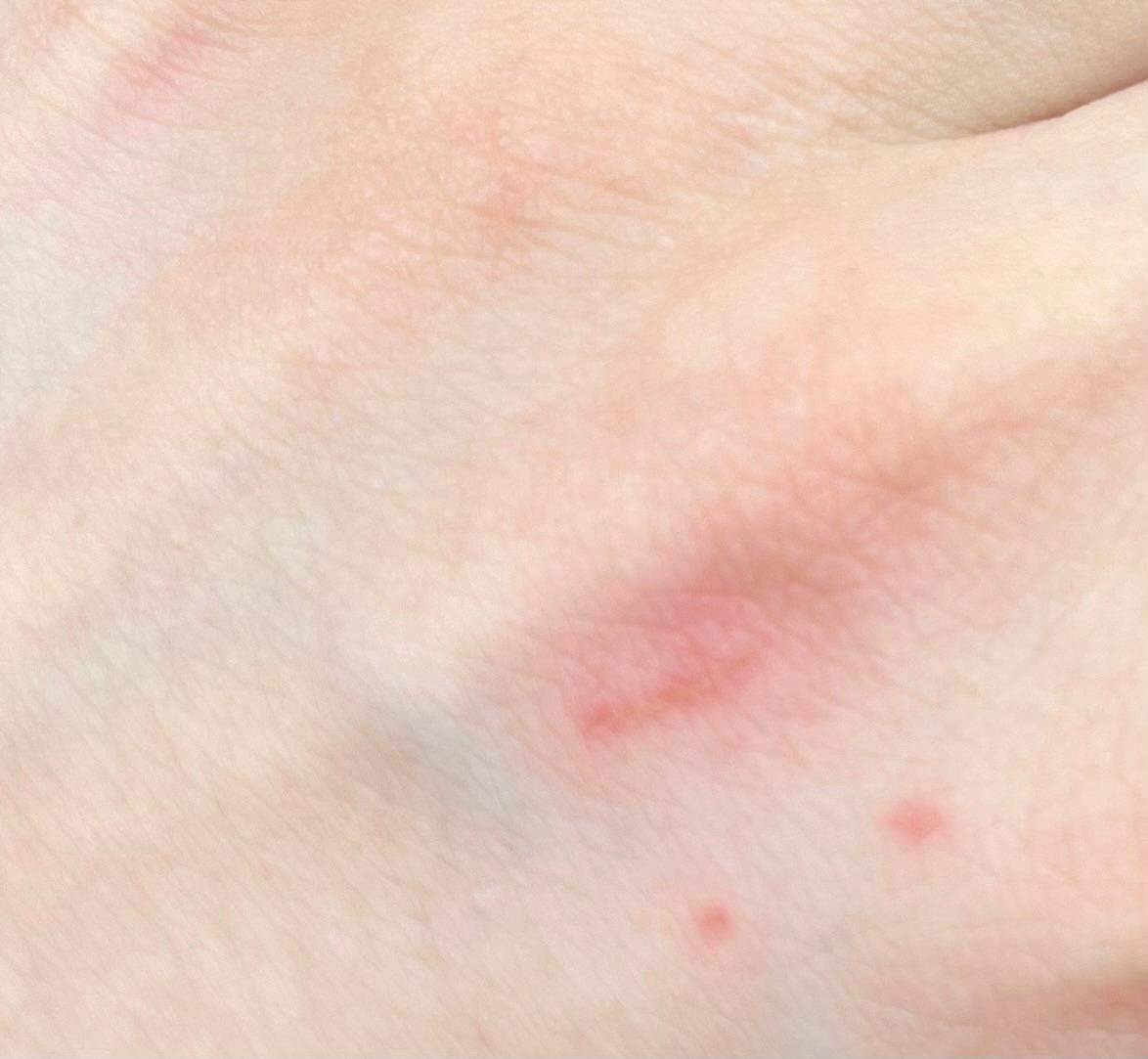 Katze Hat Mich Gekratzt Und Jetzt Schwellung Hilfe! Katze gekratzt und vergessen zu desinfizieren gefährlich