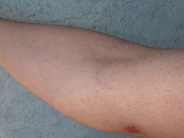 Hilfe Kleine Rote Punkte Auf Dem Arm Was Ist Das Gesundheit Und Medizin Gesundheit Allergie Hilfe Kleine Rote Punkte Auf Dem Arm Was Ist Das Gesundheit Und Medizin Gesundheit Allergie
