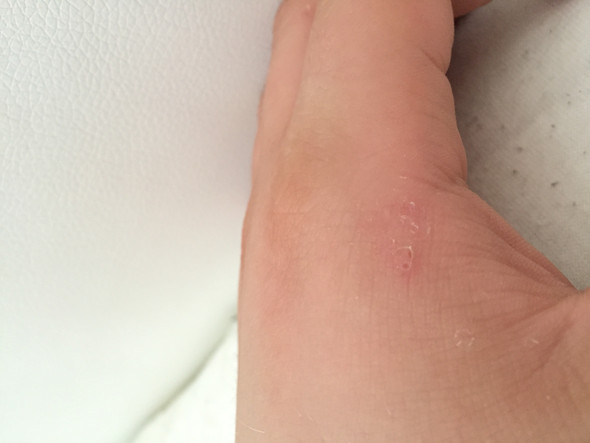 Hilfe kleine weiÃ?e Pickelchen an der Hand? (Pickel) pickel hand