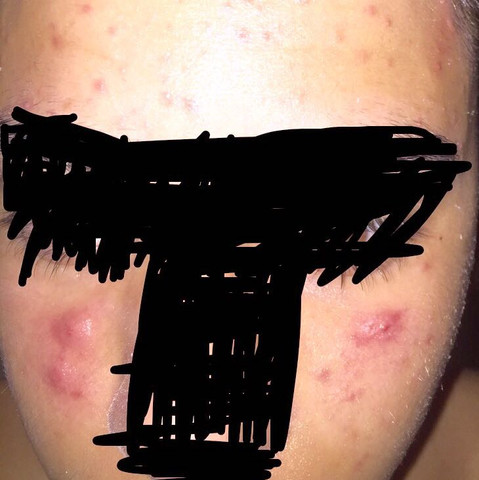 das alles habe ich in 3 tage bekommen - (Pickel, Wasistdas)
