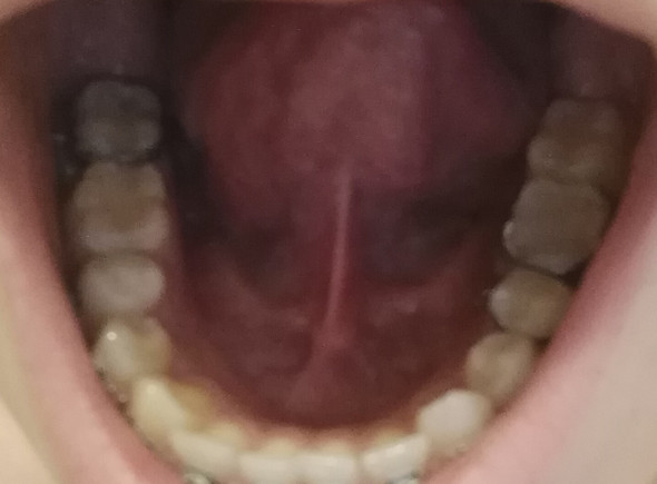 Habe Ich Eine Entzundung Unter Der Zunge Mund Habe Ich Eine Entzundung Unter Der Zunge Mund