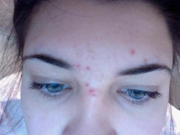 Hilfe Komische Pickel Zwischen Den Augenbrauen Ausschlag Mitesser Stirn