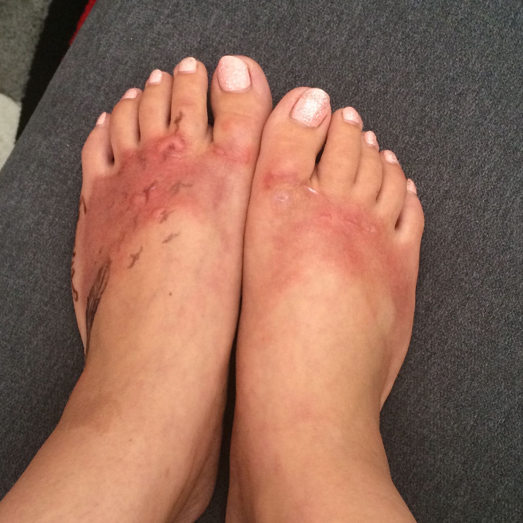 Hautausschlag Bei Kindern Mit Juckreiz Bilder