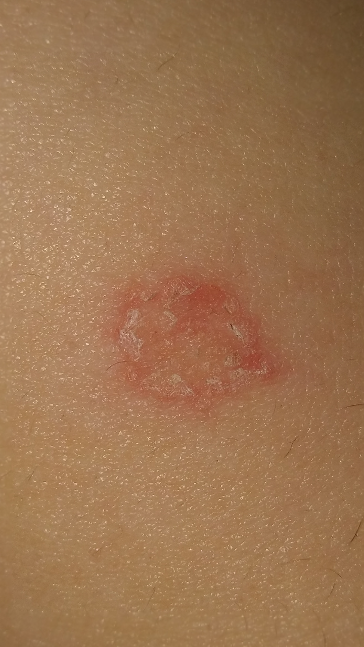 Hilfe Kreisförmige rote raue stelle? Siehe Bild? (Gesundheit, krank)