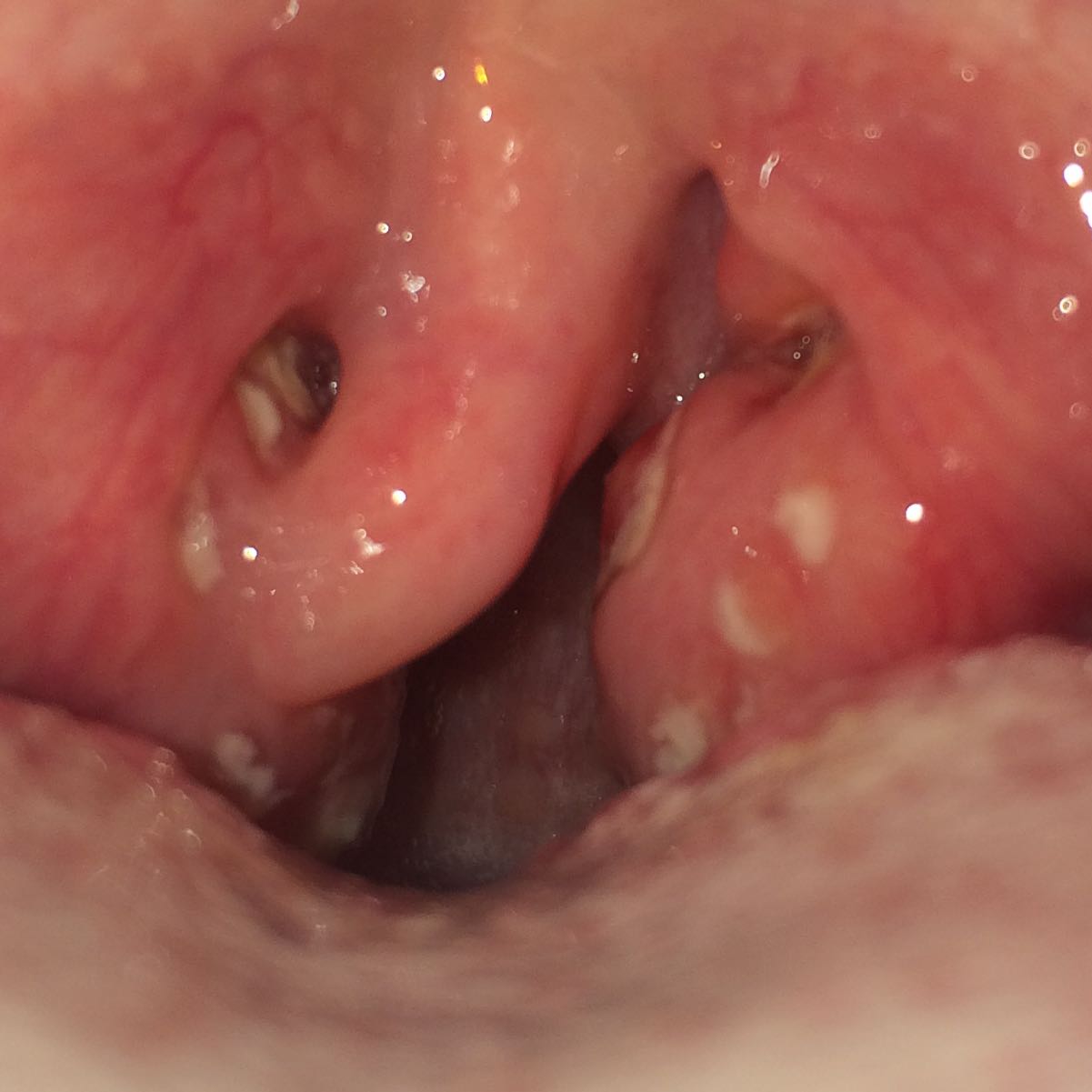 Hilfe mandelsteine mein hals schmertzt? (Schmerzen, Mandeln) Hilfe mandelsteine mein hals schmertzt? (Schmerzen, Mandeln)