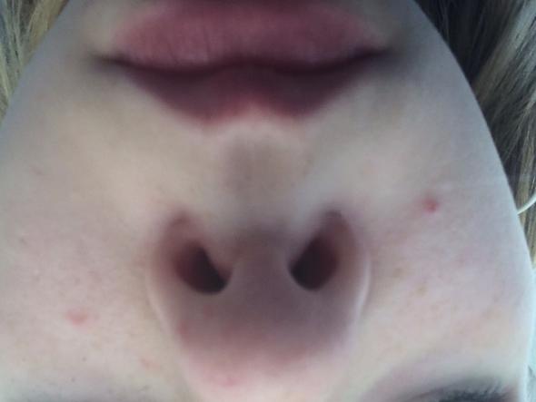 Hilfe Mein Gesicht Voller Pickel Wie Werde Ich Sie Los Wunde Mitesser