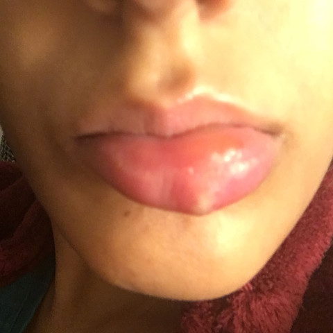 Hier ein Foto von meinem Lippenherpes.  - (Gesundheit und Medizin, Lippe, Herpes)