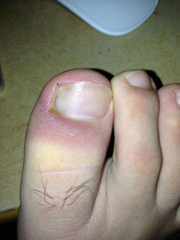 Hilfe Mein Zeh Pocht Und Tut Weh Bild Im Anhang Medizin Arzt Schmerzen Hilfe Mein Zeh Pocht Und Tut Weh Bild Im Anhang Medizin Arzt Schmerzen