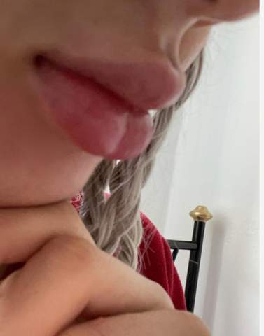 hilfe meine lippen gespalten piercing beauty lippe hyaluronsaure