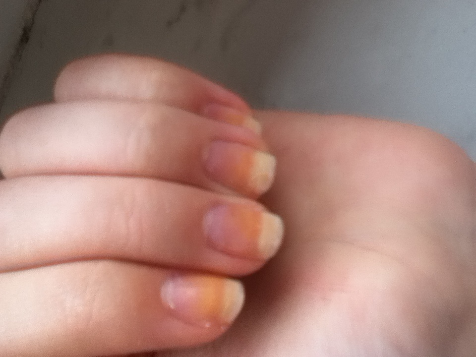 Hilfe meine Nägel haben sich vom gelben Nagellack abgefärbt (Beauty)