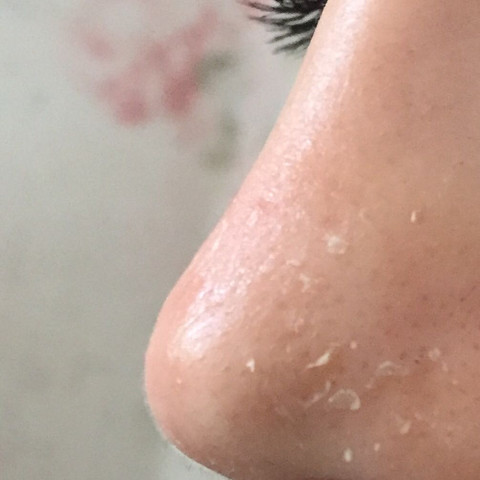 Hilfe Meine Nase Schalt Sich Was Tun Haut Hilfe Meine Nase Schalt Sich Was Tun Haut