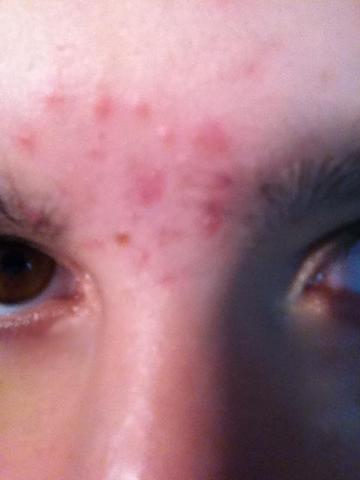 Hilfe Pickel Bitte Lesen Mit Bild Beauty Gesicht