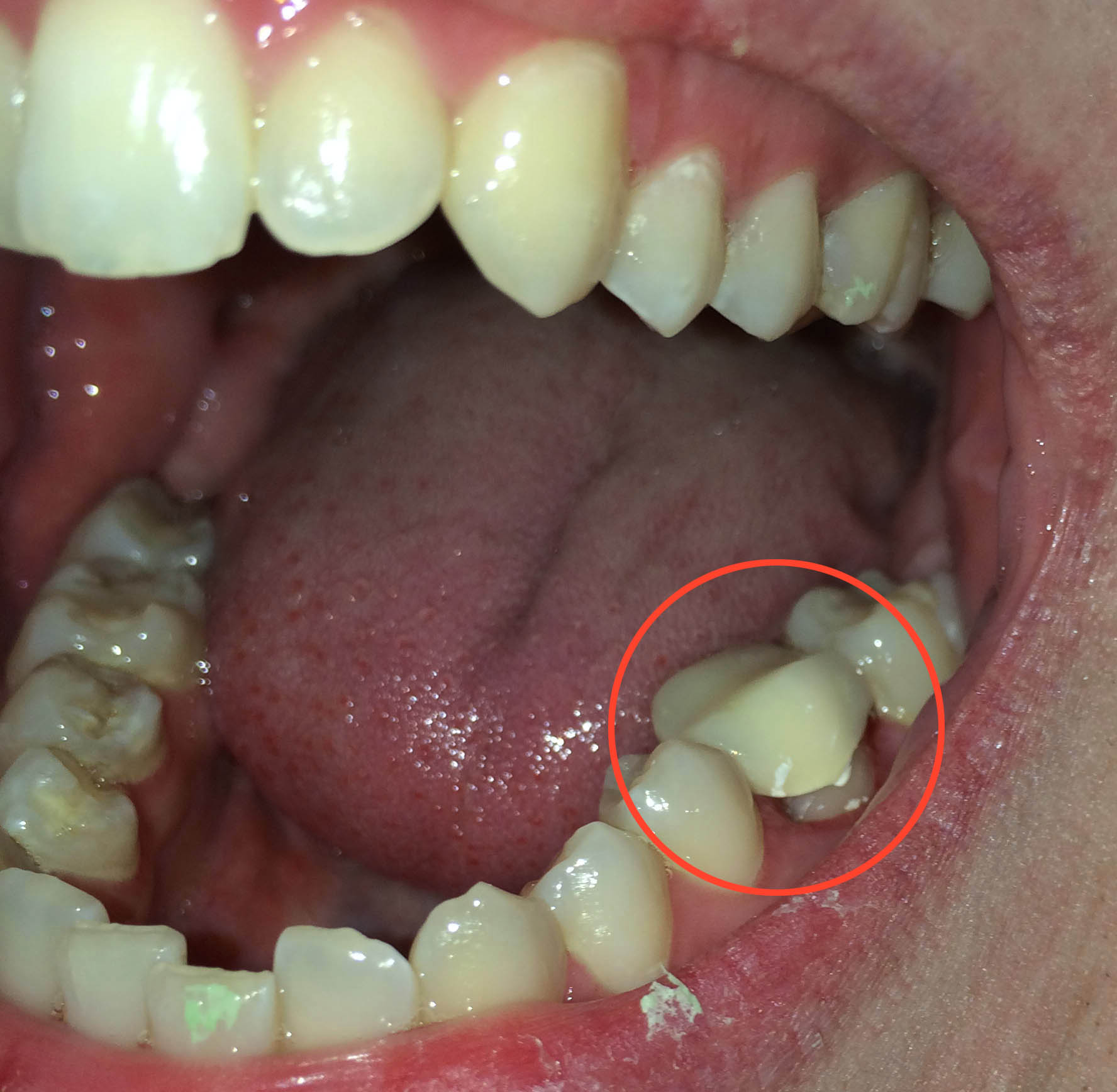 Hilfe: Provisorium falsch eingesetzt? (Zahnarzt, Zahnmedizin, Zahnersatz)