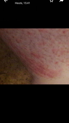 Hilfe Punkte Auf Der Haut Was Ist Das Gesundheit Und Medizin Brennen Hilfe Punkte Auf Der Haut Was Ist Das Gesundheit Und Medizin Brennen