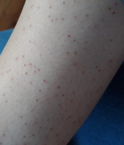 Hilfe Rote Punkte Auf Den Beinen Haut Rasieren Hilfe Rote Punkte Auf Den Beinen Haut Rasieren