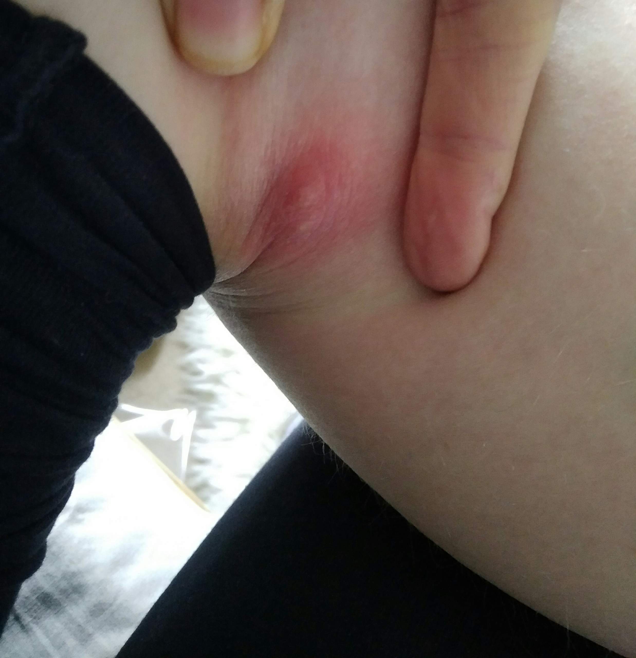 Hilfe Rote Schmerzende Erhebung In Der Kniekehle Mit Bild Pickel Entzundung Knie Hilfe Rote Schmerzende Erhebung In Der Kniekehle Mit Bild Pickel Entzundung Knie